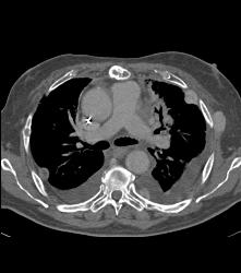 Metastases to Pericardium - CTisus CT Scan