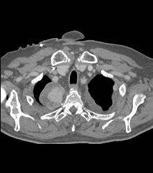 Metastases to Pericardium - CTisus CT Scan