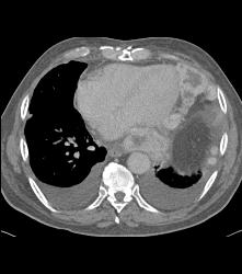 Sarcoma of Left Atrial Appendage - CTisus CT Scan