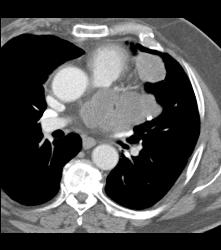 Sarcoma of Left Atrial Appendage - CTisus CT Scan