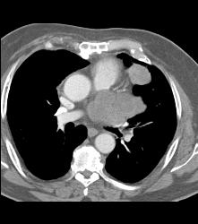 Sarcoma of Left Atrial Appendage - CTisus CT Scan