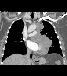 Sarcoma of Left Atrial Appendage - CTisus CT Scan