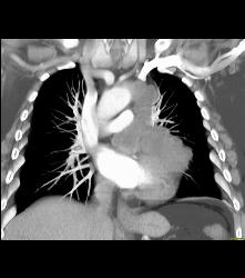 Sarcoma of Left Atrial Appendage - CTisus CT Scan