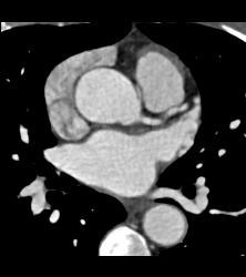 Left Anterior Descending Coronary Artery (LAD) Disease - CTisus CT Scan