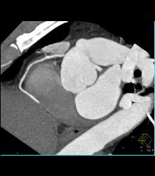 Minimal Right Coronary Artery (RCA) Plaque - CTisus CT Scan