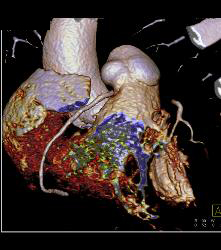 RCA Arises Off Left Cusp in Malignant Location - CTisus CT Scan