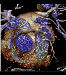 RCA Arises Off Left Cusp in Malignant Location - CTisus CT Scan