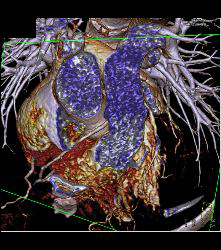 RCA Arises Off Left Cusp in Malignant Location - CTisus CT Scan