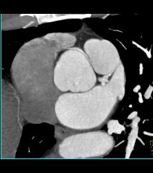 RCA Arises Off Left Cusp in Malignant Location - CTisus CT Scan