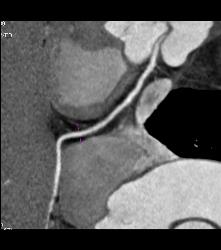 RCA Arises Off Left Cusp in Malignant Location - CTisus CT Scan