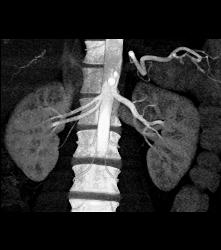 2 Right Renal Arteries in Ehlers-Danlos - CTisus CT Scan