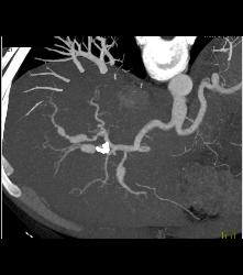 Hepatic Artery Aneurysms in Ehlers-Danlos - CTisus CT Scan