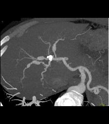 Hepatic Artery Aneurysms in Ehlers-Danlos - CTisus CT Scan