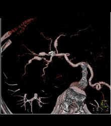 Hepatic Artery Aneurysms in Ehlers-Danlos - CTisus CT Scan