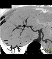 Hepatic Artery Aneurysms in Ehlers-Danlos - CTisus CT Scan