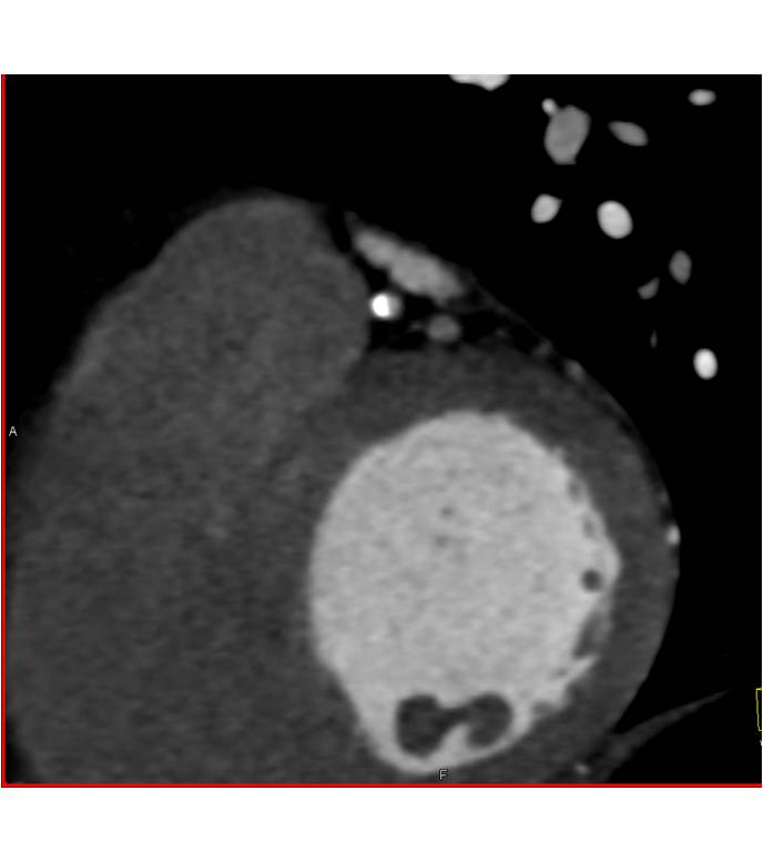 CCTA with Multivessel Disease with Left Anterior Descending Coronary Artery (LAD) Stenosis - CTisus CT Scan