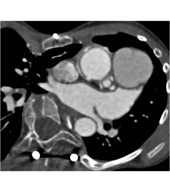 Aortic Root Repair with Dilated Reimplanted Coronary Arteries in 3D - CTisus CT Scan