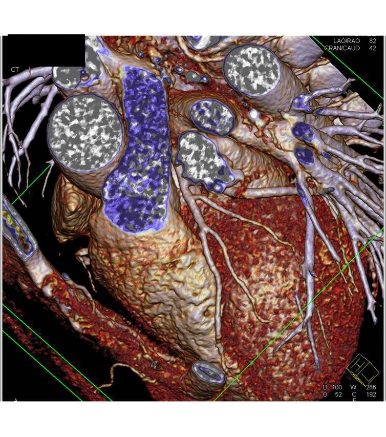 CCTA with Normal Coronary Arteries with SA Nodal Branch Arising off the Circumflex Coronary Artery - CTisus CT Scan