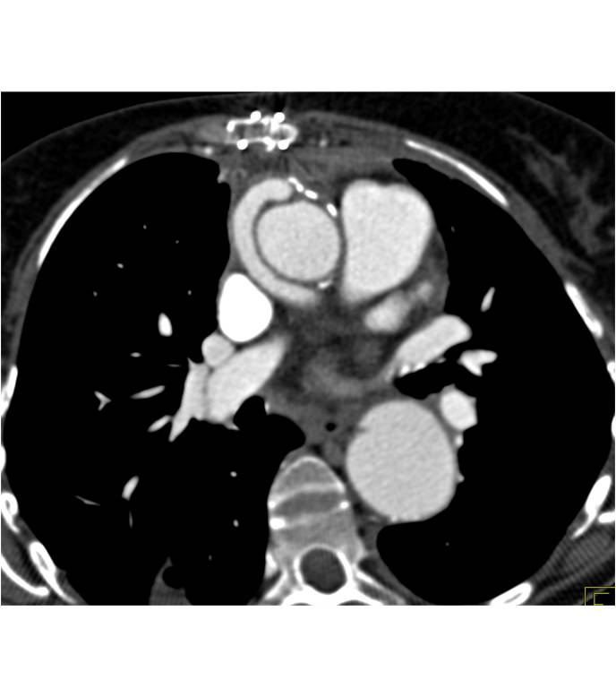 CCTA: Aortic Root Repair with Reimplanted Left Coronary Artery off Right Cusp-Note Its Pathway - CTisus CT Scan