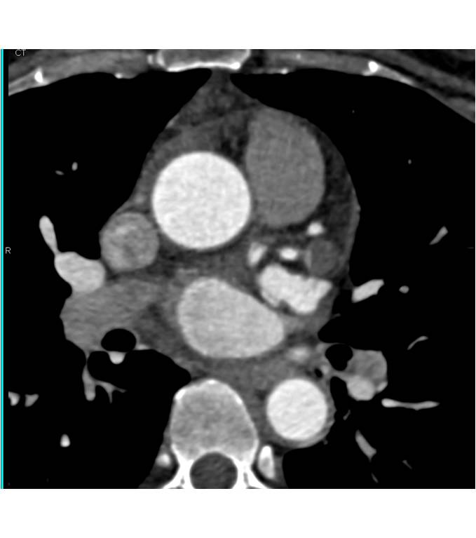 CCTA; Occluded Circumflex Coronary Artery as well as Circumflex Coronary Artery Aneurysm - CTisus CT Scan