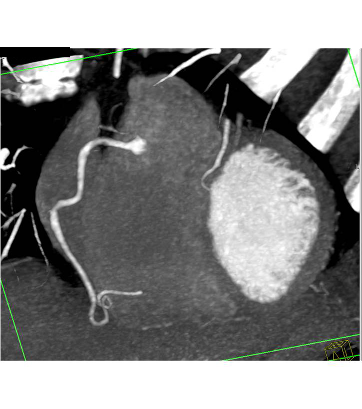 CCTA: Normal Right Coronary Artery that is Dominant - CTisus CT Scan