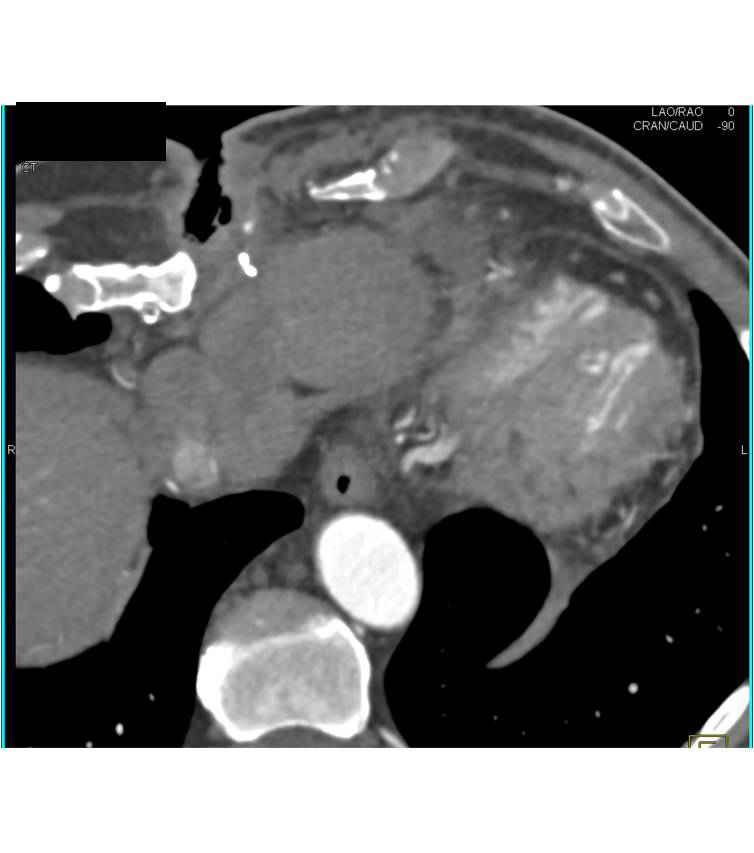 CCTA: Aortic Valve Repair with Coronary Artery Disease and Reimplanted Coronary Arteries - CTisus CT Scan