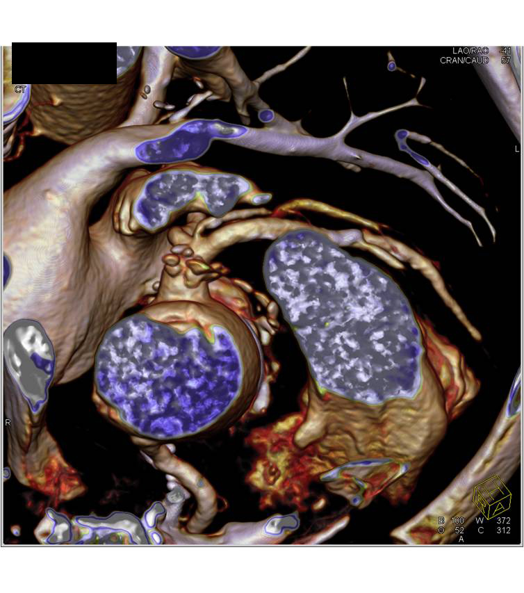 CCTA: Left Anterior Descending Coronary Artery (LAD) Plaque without Significant Stenosis - CTisus CT Scan