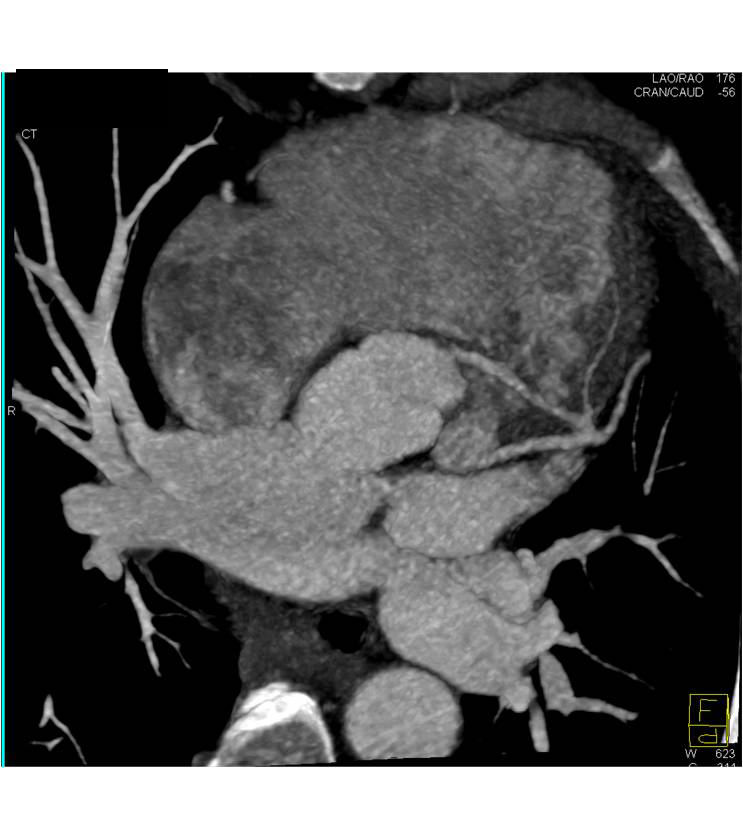 CCTA: Left Anterior Descending Coronary Artery (LAD) Arises off Right Cusp - CTisus CT Scan