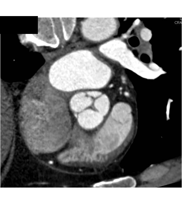 Normal Aortic Valve - CTisus CT Scan