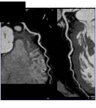 CCTA: Normal Left Anterior Descending Coronary Artery (LAD) - CTisus CT Scan