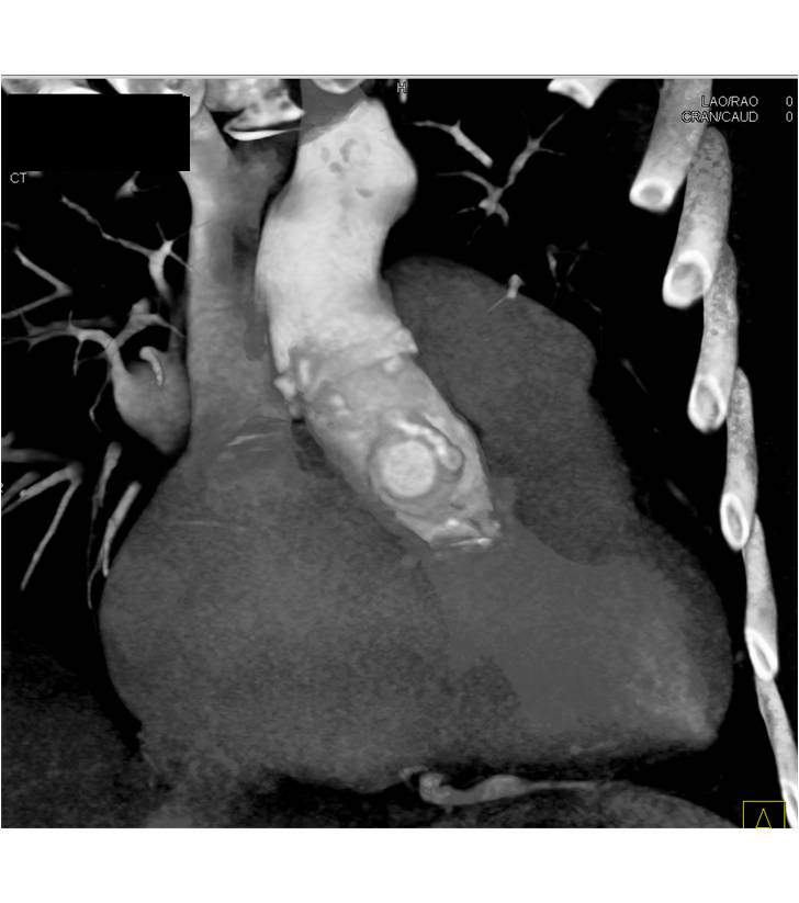 Marfan Syndrome with Composite Graft and Dilatation of Reimplanted Coronary Arteries - CTisus CT Scan