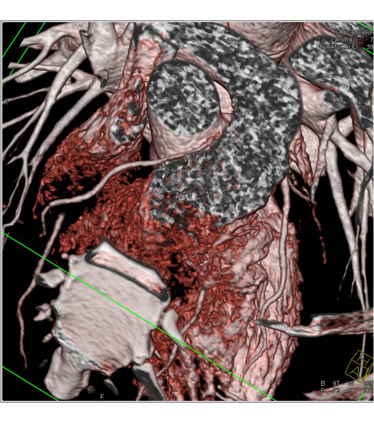 CCTA: Right Coronary Artery (RCA) Arises off Left Cusp and Tracks between Aorta and Pulmonary Trunk in a so called Malignant Configuration - CTisus CT Scan