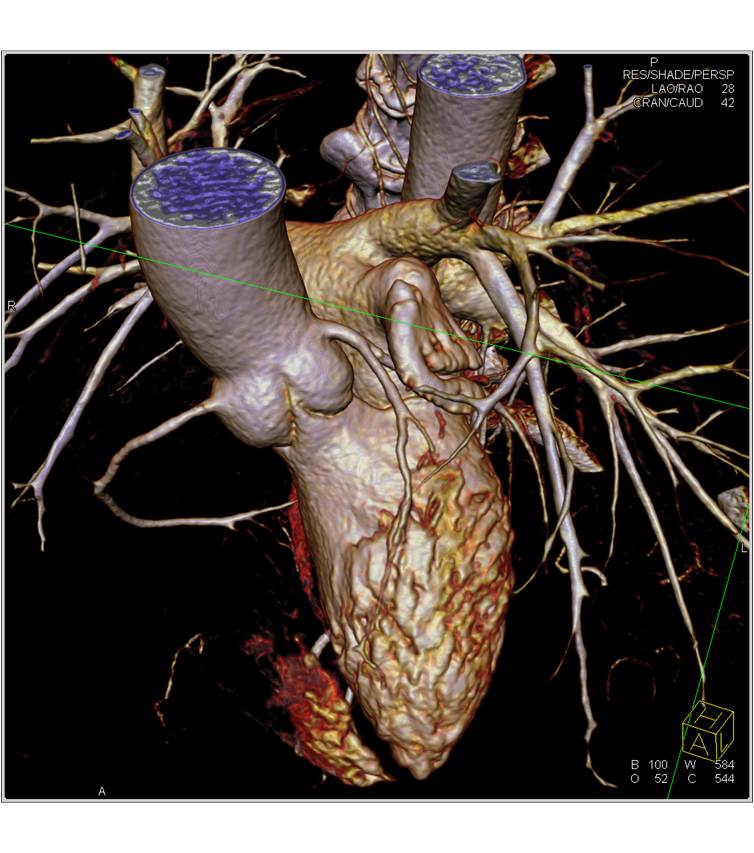 CCTA: VRT Display of the Coronary Arteries - CTisus CT Scan