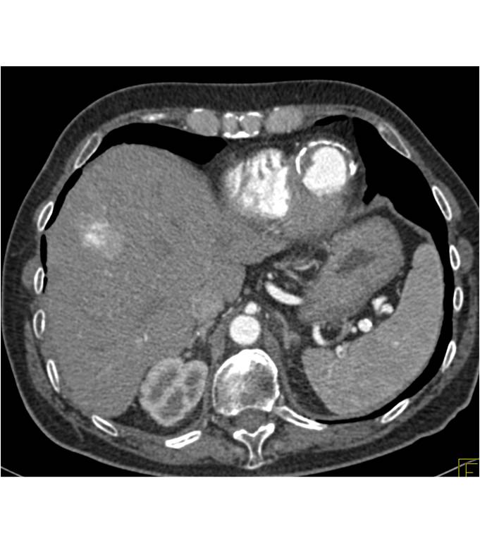 Left Ventricular Aneurysm - CTisus CT Scan