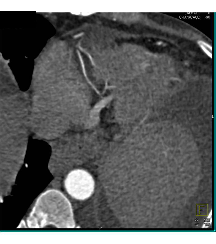 CCTA: Left Dominant Circulation - CTisus CT Scan