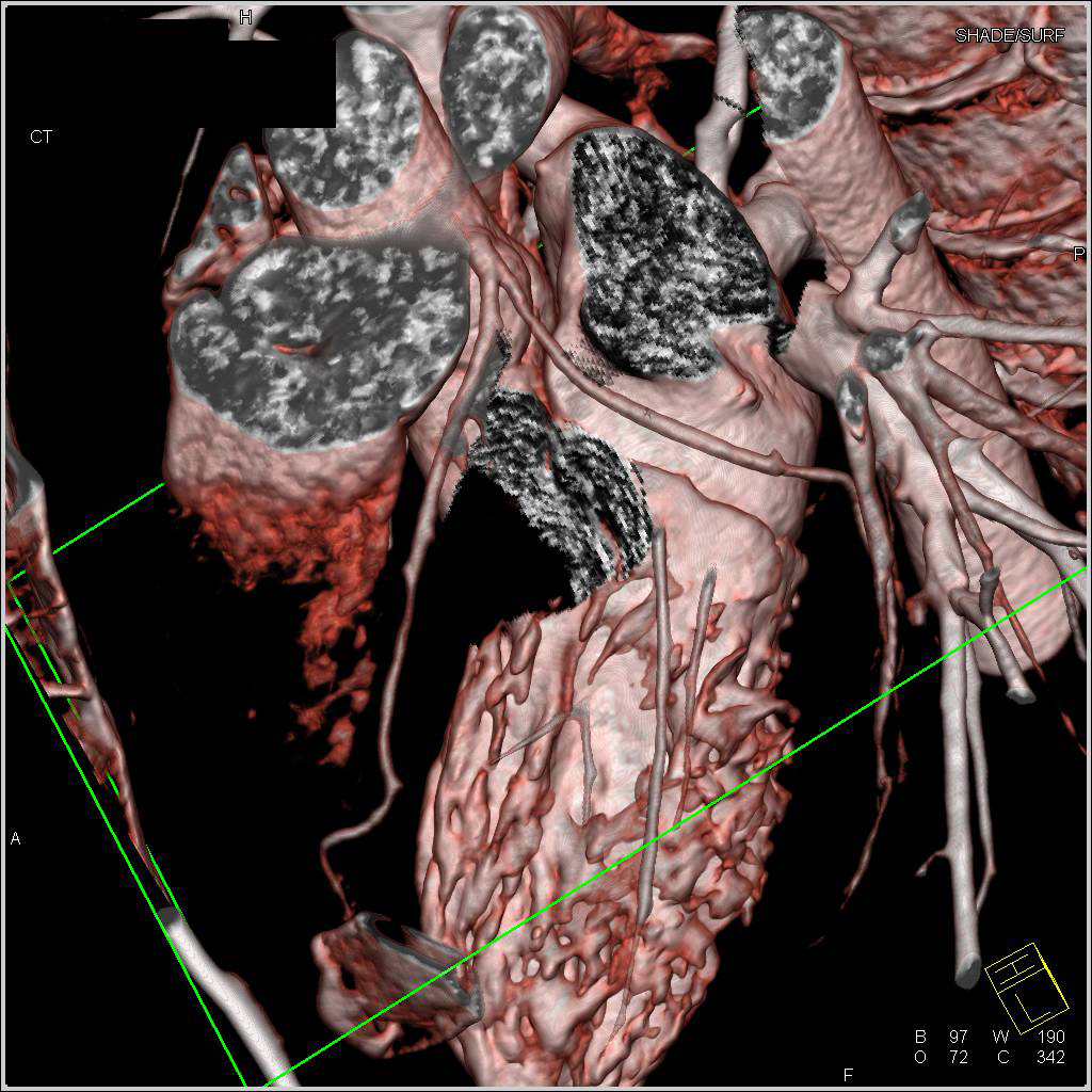 CCTA: Normal Coronary Arteries in 3D - CTisus CT Scan