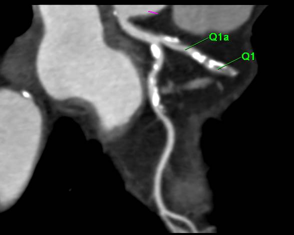 CCTA with Multivessel Disease with Left Anterior Descending Coronary Artery (LAD) Stenosis of over 70% - CTisus CT Scan