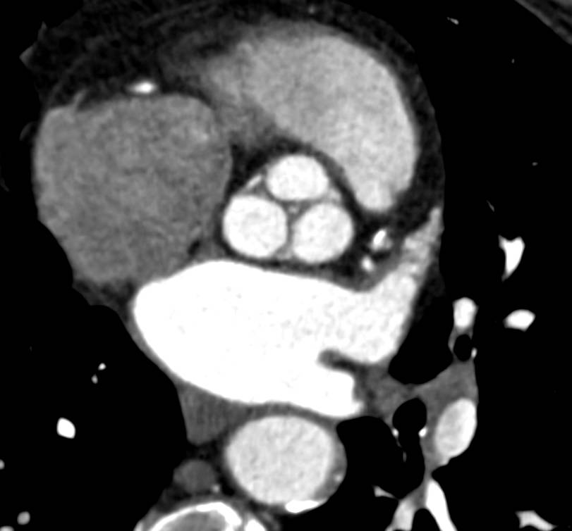 CCTA with Multivessel Disease with Left Anterior Descending Coronary Artery (LAD) Stenosis as well as Thickened Aortic Valve Leaflets - CTisus CT Scan