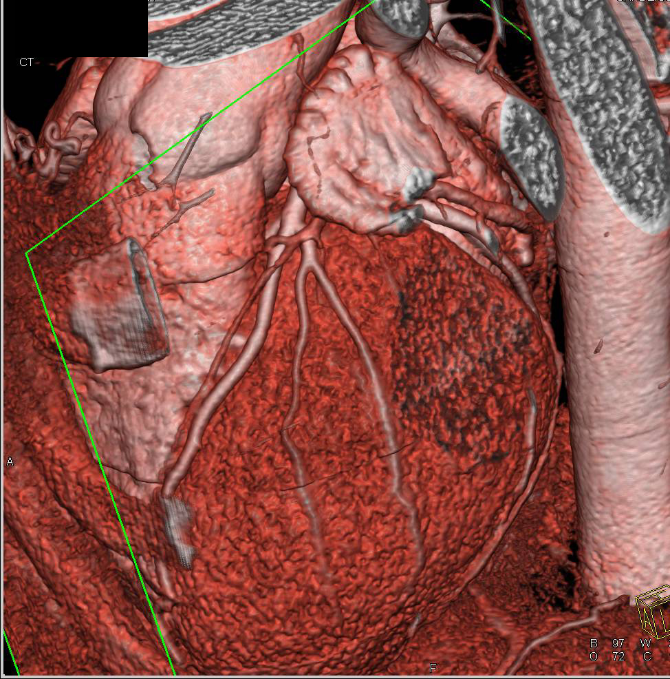 CCTA: Left Anterior Descending Coronary Artery (LAD) with Result of Irregular Heart Rate - CTisus CT Scan