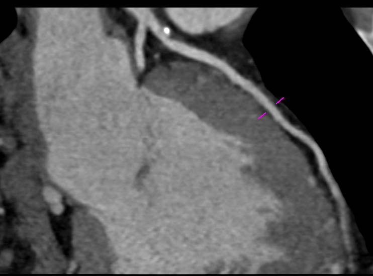 CCTA: Mixed Plaque in Left Anterior Descending Coronary Artery (LAD) with 50% Stenosis - CTisus CT Scan