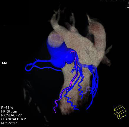 CCTA: Multivessel Disease with Calcified Plaques Without Critical Stenosis Shown in Multiple Renderings - CTisus CT Scan