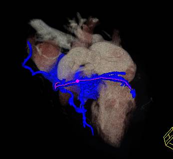 CCTA: Left Anterior Descending Coronary Artery (LAD) Disease with 59% Stenosis - CTisus CT Scan