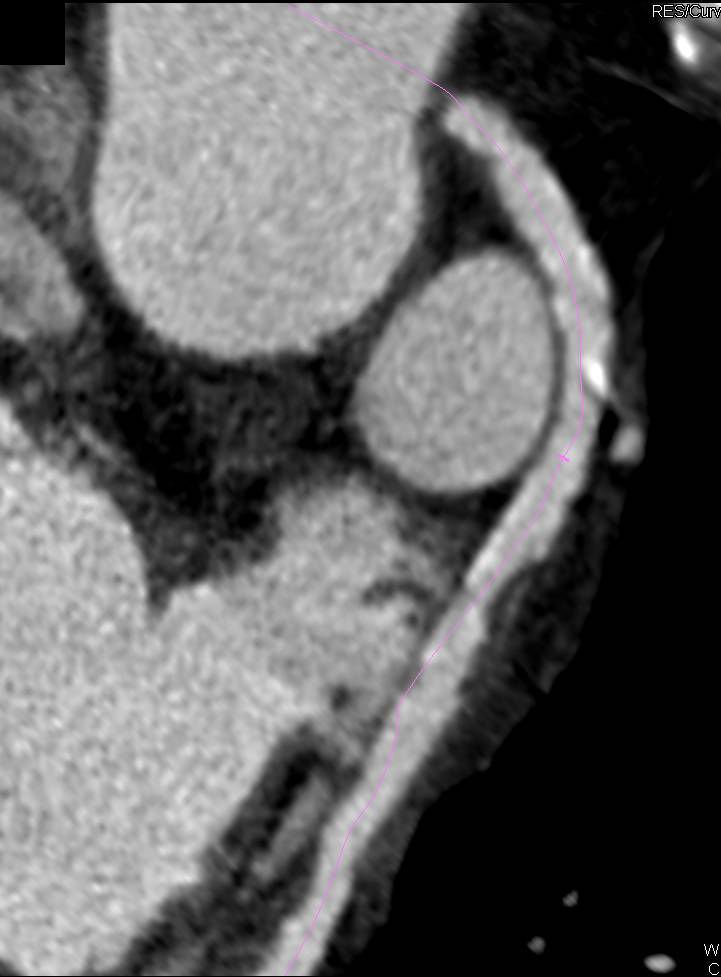 Coronary Bypass Grafts with Diseased Native Vessels. Stenosis Approaches 50%. - CTisus CT Scan