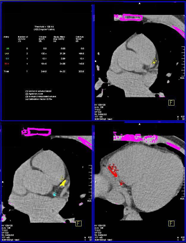 CCTA: Multiple Calcified and Noncalcified  Plaques with Elevated Calcium Score - CTisus CT Scan