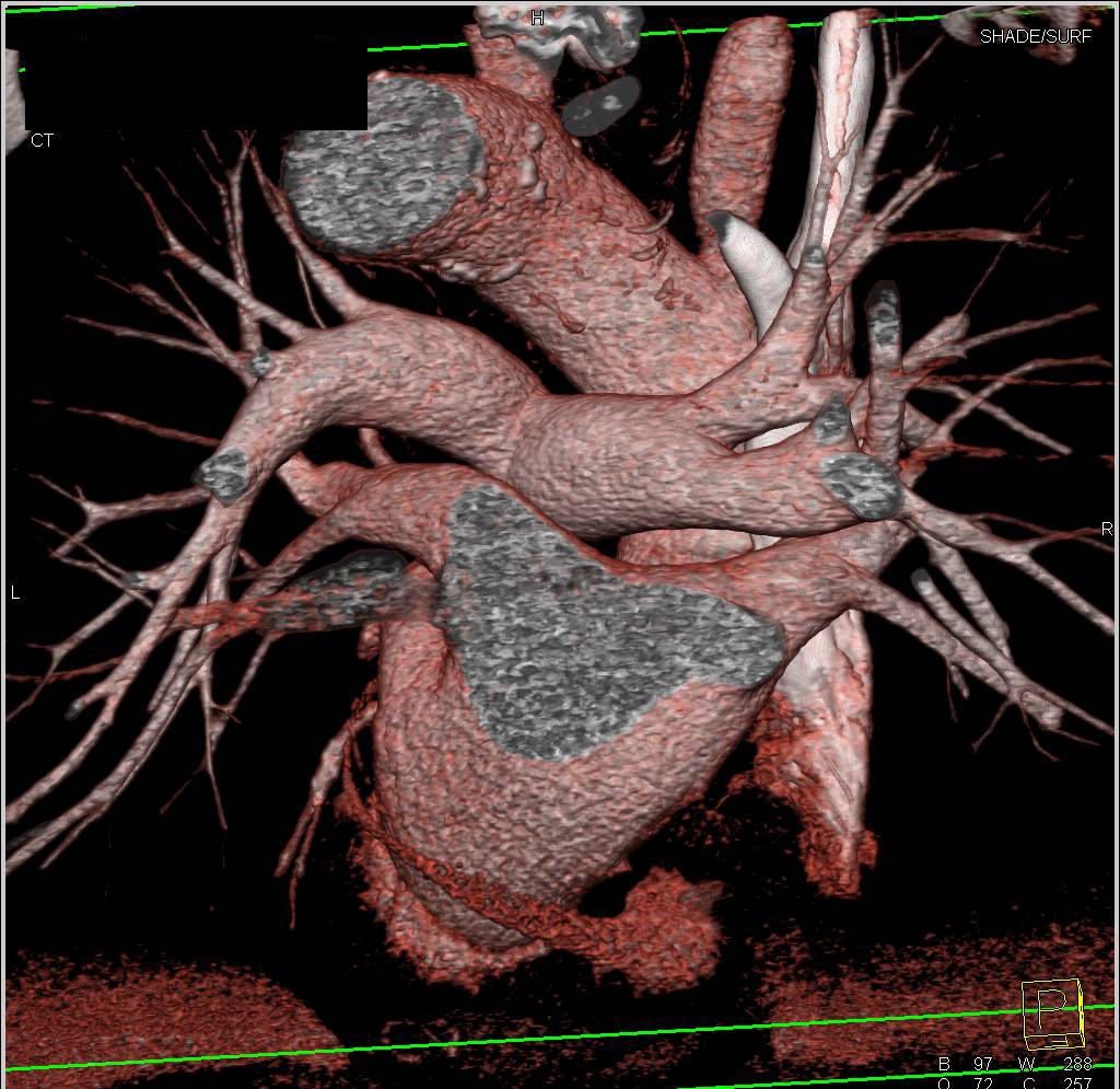 3D Mapping of the Pulmonary Veins and Artery - CTisus CT Scan