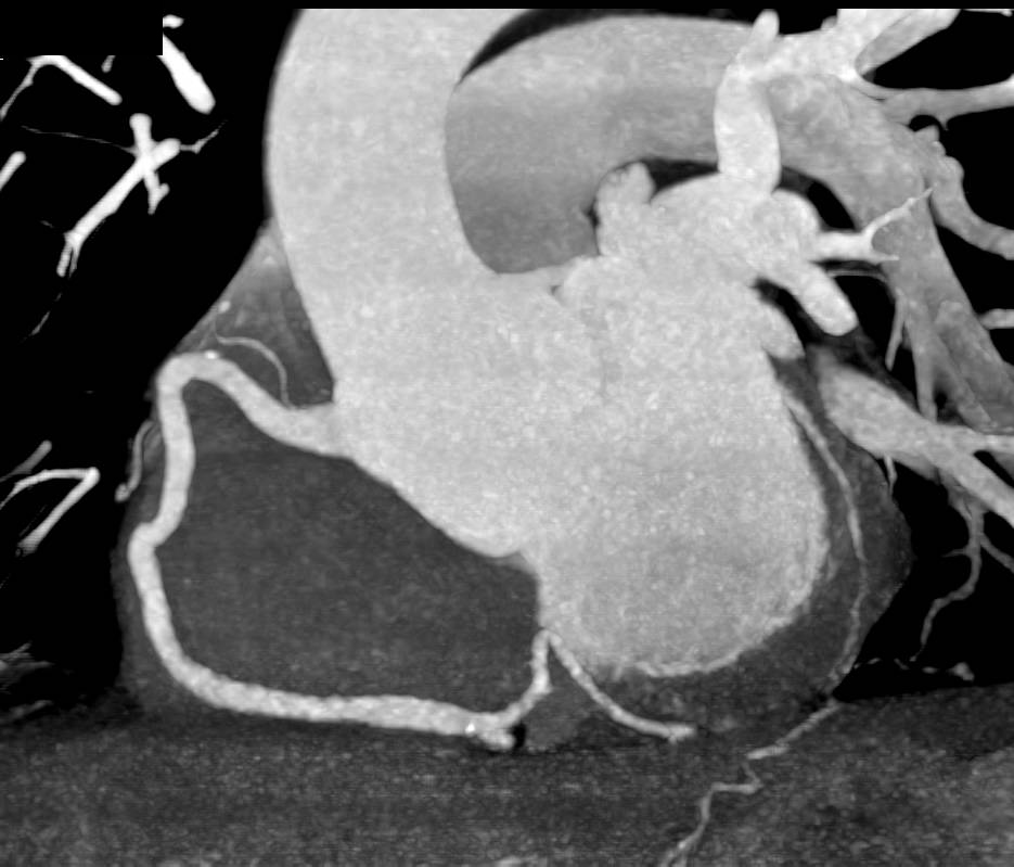 CCTA: Coronary CT Angiogram with Minimal Plaque - CTisus CT Scan