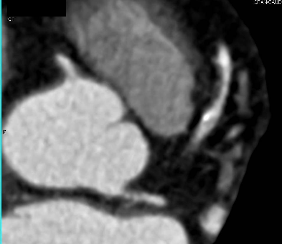 CCTA: Left Anterior Descending Coronary Artery (LAD) Disease with Greater than 50% Stenosis with Mixed Plaque - CTisus CT Scan