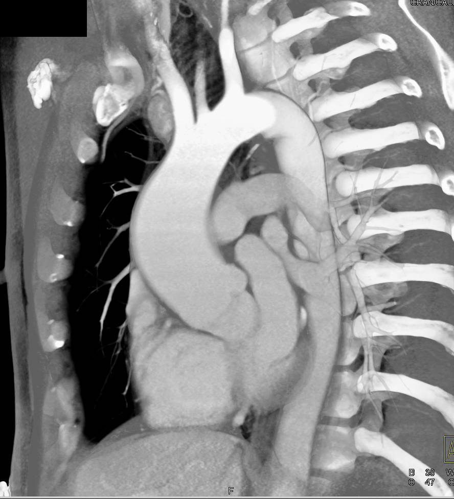 Thickened Aortic Valve with Dilated Ascending Aorta and Calcified PDA (Patent Ductus Arteriosus) - CTisus CT Scan
