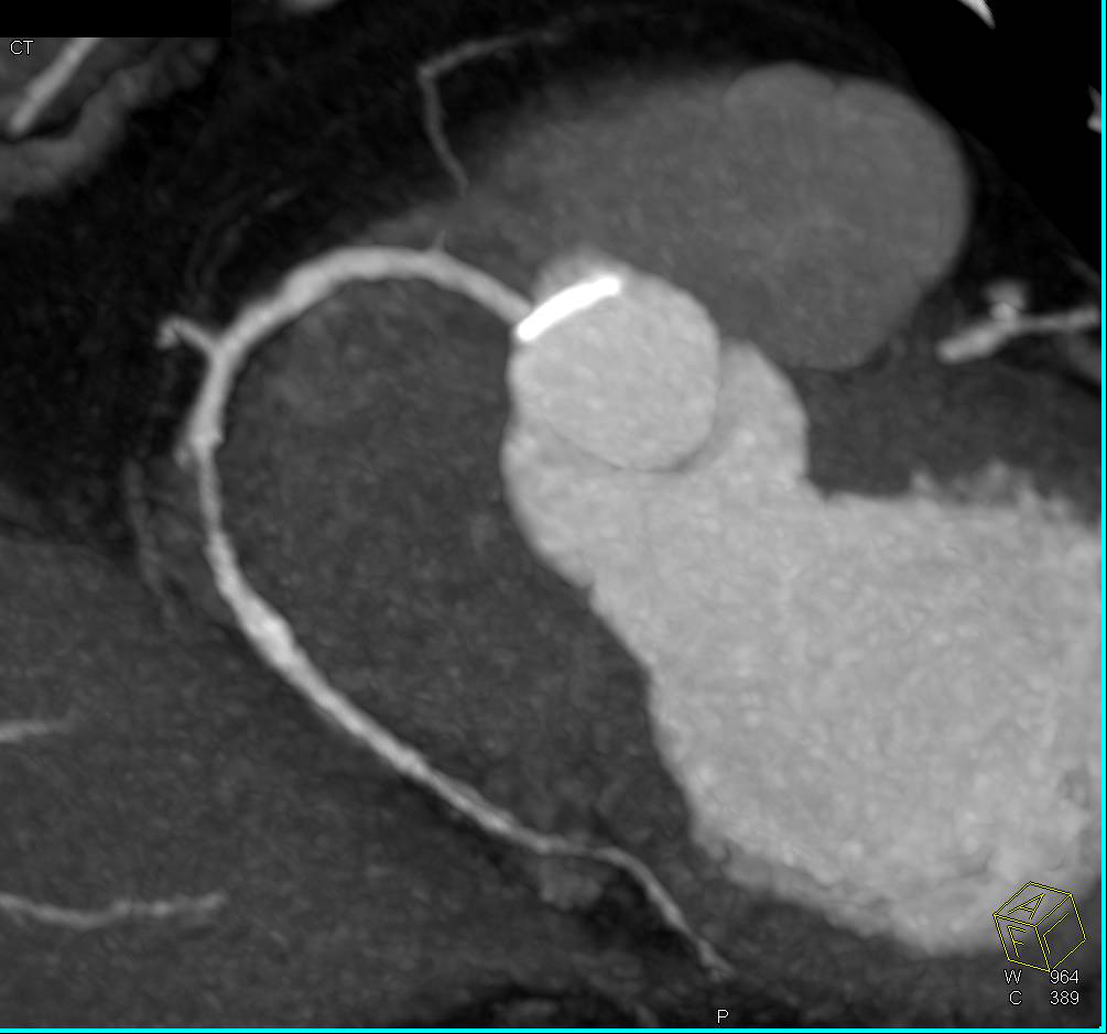 CCTA: Coronary CT Angiogram with Right Coronary Artery (RCA) Stenosis of Over 50% - CTisus CT Scan