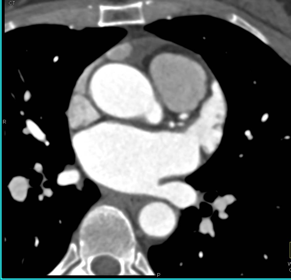 Normal Appearance of the Left Atrial Appendage - CTisus CT Scan